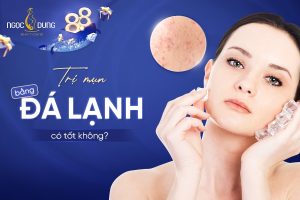Trị mụn bằng đá lạnh có tốt không? Những lưu ý cần nắm
