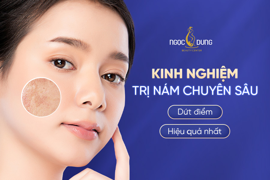 5 cách trị nám da tận gốc từ bên trong hiệu quả nhất hiện nay