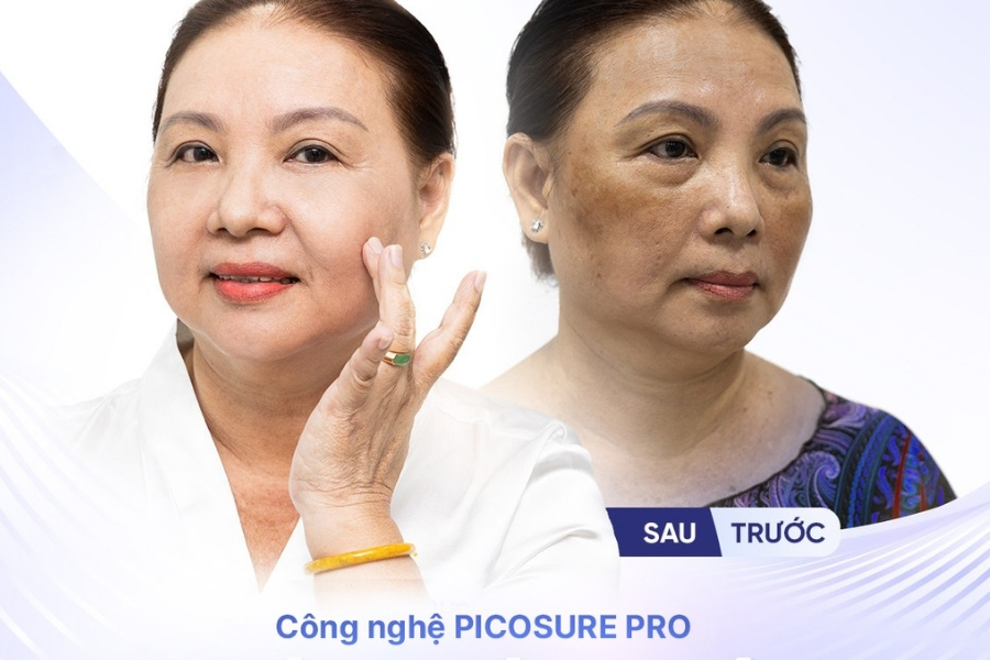 Với Laser Picosure và các phương pháp trị tăng sắc tố tiên tiến, bạn sẽ thấy sự cải thiện tàn nhang rõ rệt ngay từ liệu trình đầu tiên