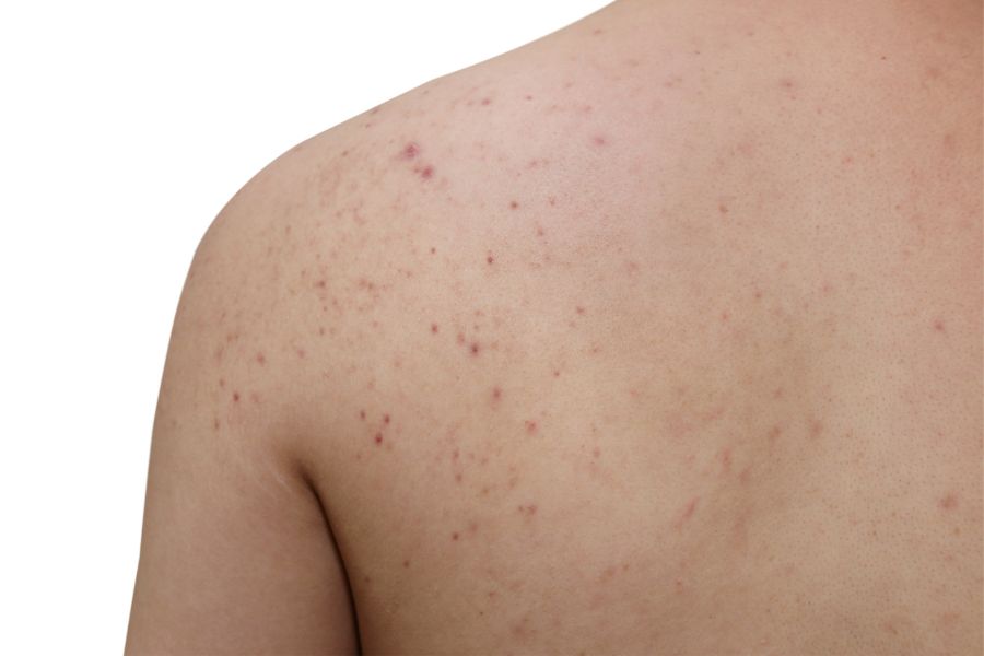 Mụn ở lưng nếu không trị đúng cách cũng có thể để lại thâm