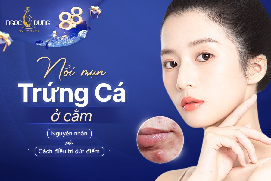 Mụn trứng cá ở cằm: Dấu hiệu, nguyên nhân và cách điều trị