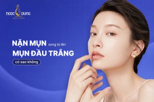 Nặn mụn xong bị lên mụn đầu trắng