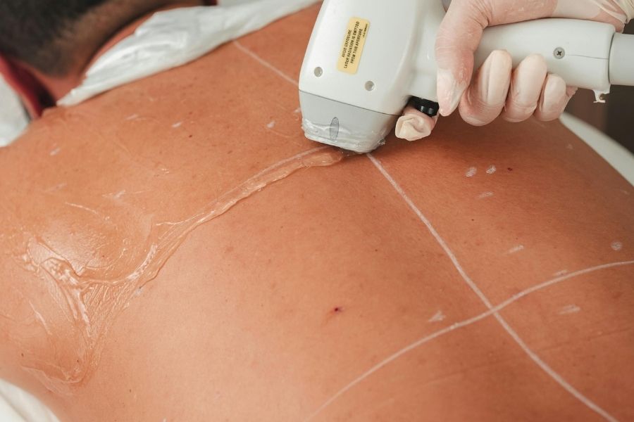Châm chích nhẹ là cảm giác bình thường khi triệt lông với công nghệ cao