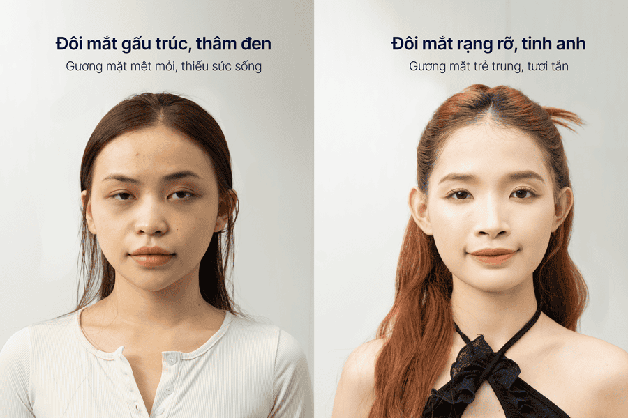 Kết quả điều trị thâm mắt tại TMV Ngọc Dung