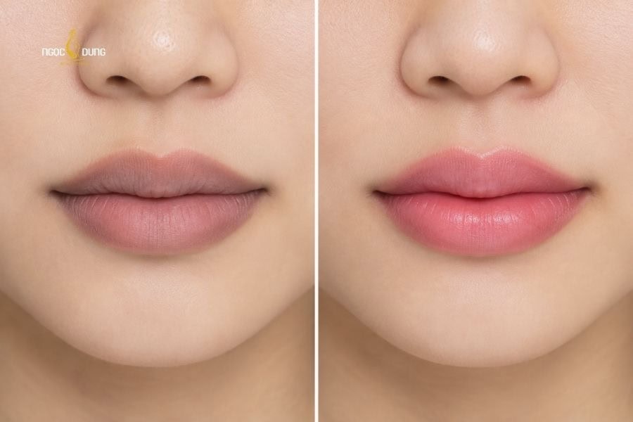 Khử thâm môi mang lại nét đẹp tự nhiên và trong veo