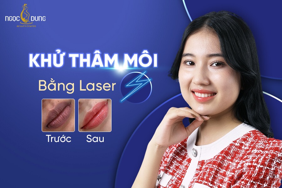 Khử thâm môi bằng Laser được đông đảo khách hàng tin chọn