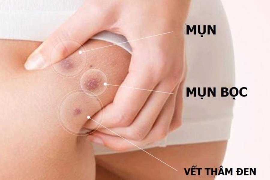 Mụn mông gây ra những vết thâm đen không mong muốn