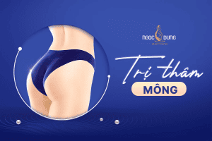 Nên trị thâm mông tại nhà hay laser?