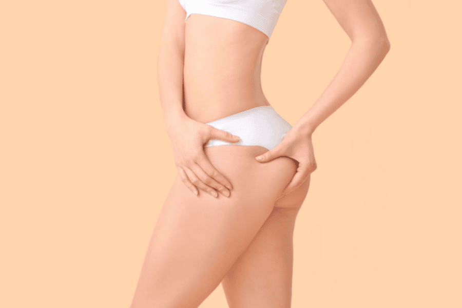 10+ cách trị thâm mông tại nhà và bằng công nghệ cao hiệu quả 10 Những cách giúp hạn chế thâm mông