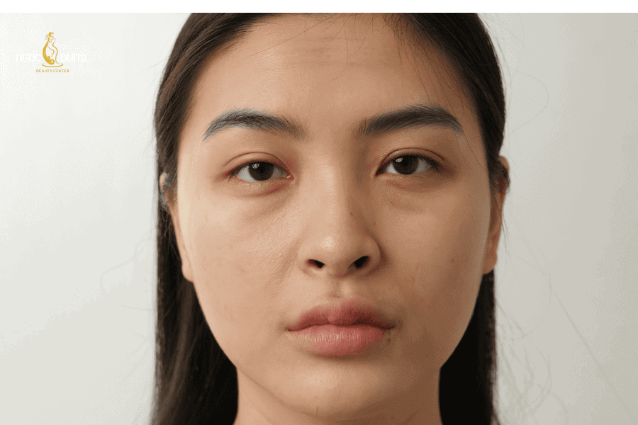 Quá trình lão hóa tự nhiên khiến mắt xuất hiện quầng thâm rõ hơn 