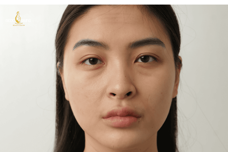 Quá trình lão hóa tự nhiên khiến mắt xuất hiện quầng thâm rõ hơn 