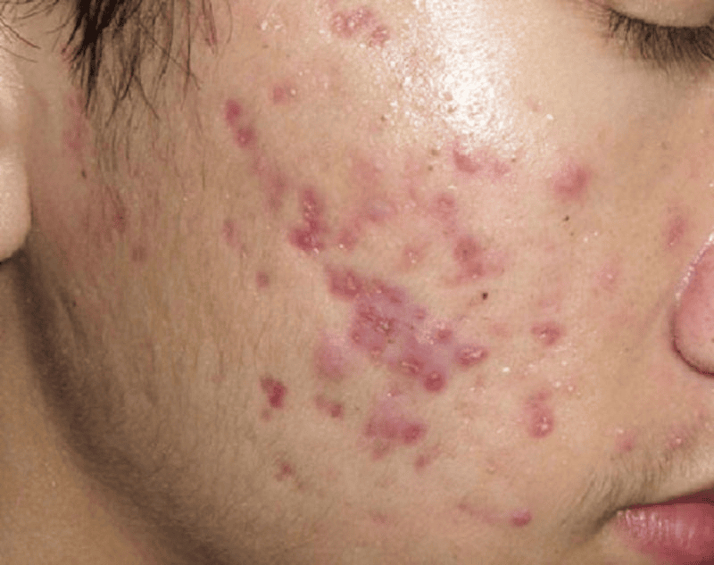 Thâm đỏ sau mụn có thể kéo dài nếu không điều trị đúng cách 