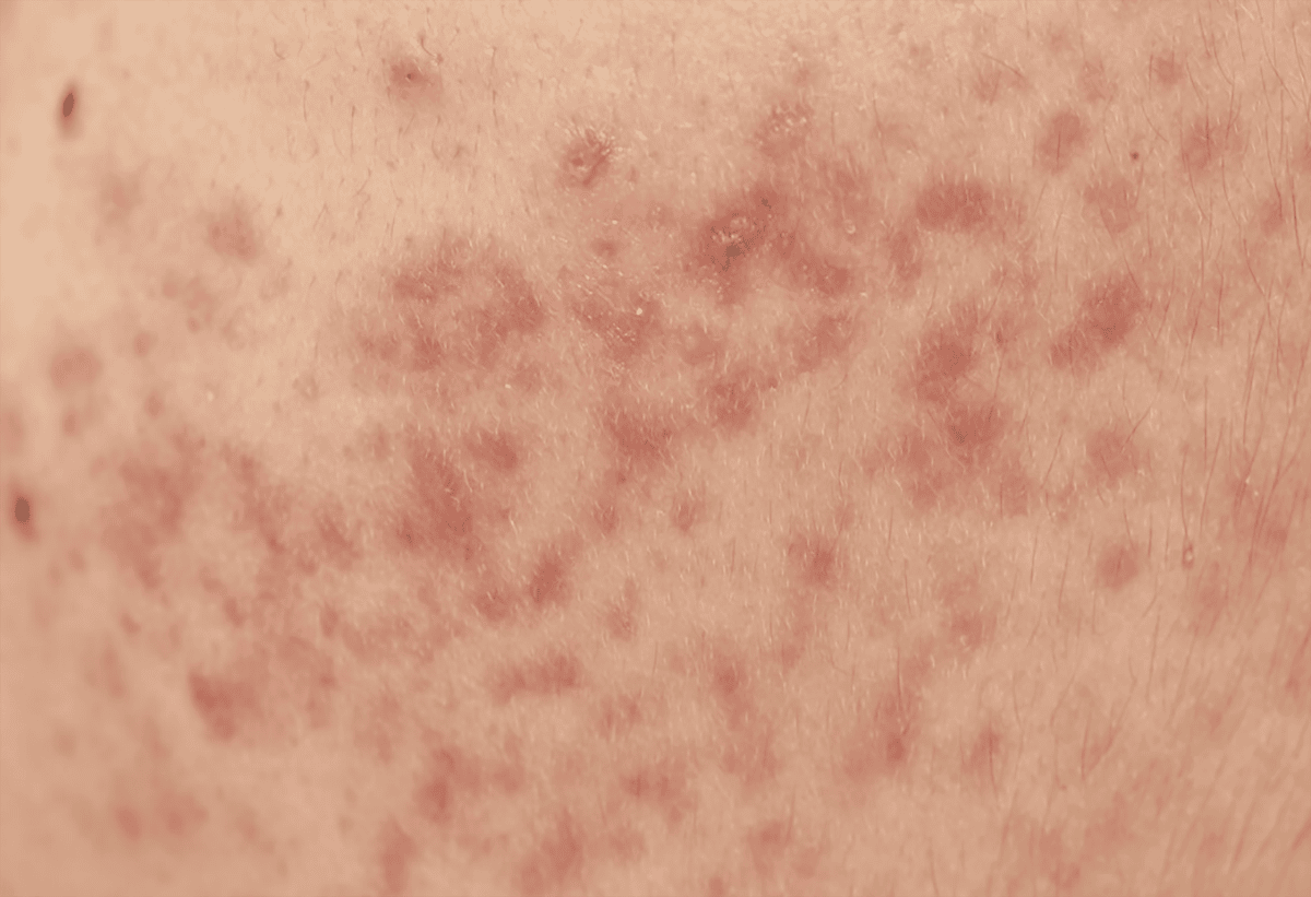 Thâm đỏ sau mụn thường khó điều trị hơn thâm đen 