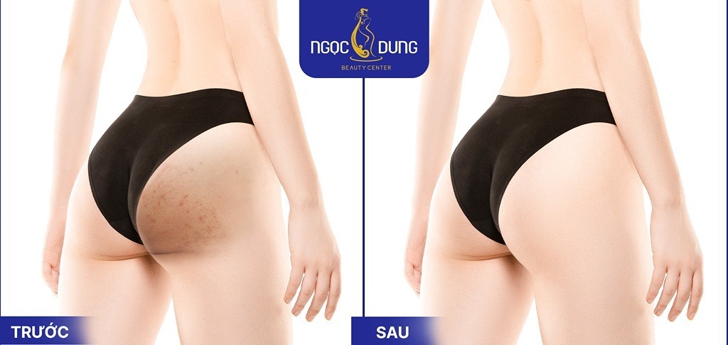 Vùng da mông sáng mịn đều màu sau 1 liệu trình trị thâm mông tại Thẩm mỹ viện Ngọc Dung
