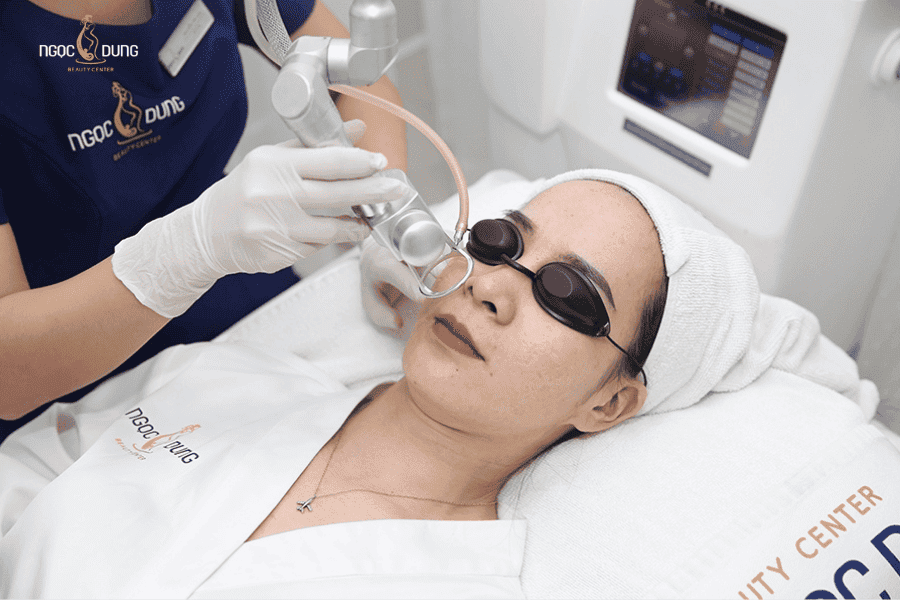 Trị thâm mụn hiệu quả bằng Laser tại TMV Ngọc Dung 