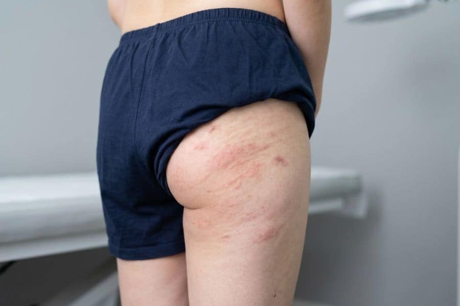 Đánh giá tình trạng da trước khi đi tia Laser giúp hạn chế tối đa nguy cơ bỏng rát