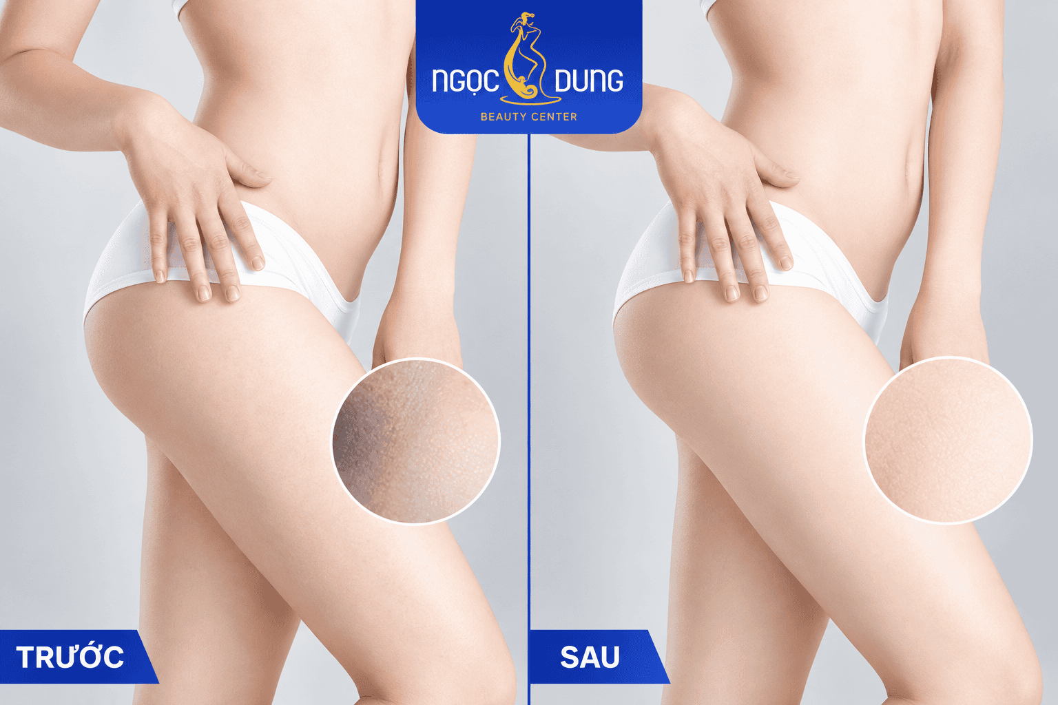 Giảm thâm bẹn chỉ sau 1 liệu trình tại Thẩm mỹ viện Ngọc Dung