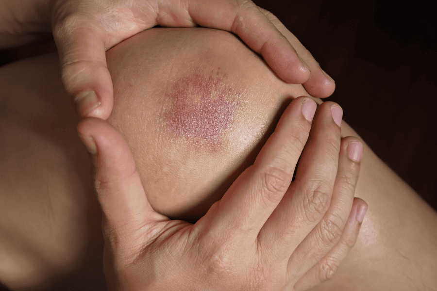 Nguyên nhân khiến vùng da đầu gối bị thâm đen