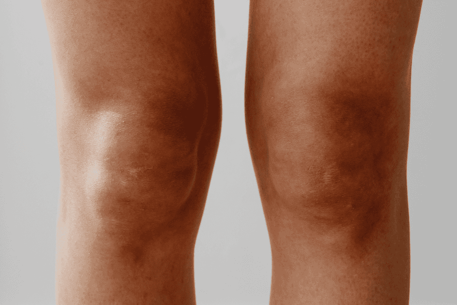 Thâm đầu gối do ma sát cơ học là chủ yếu