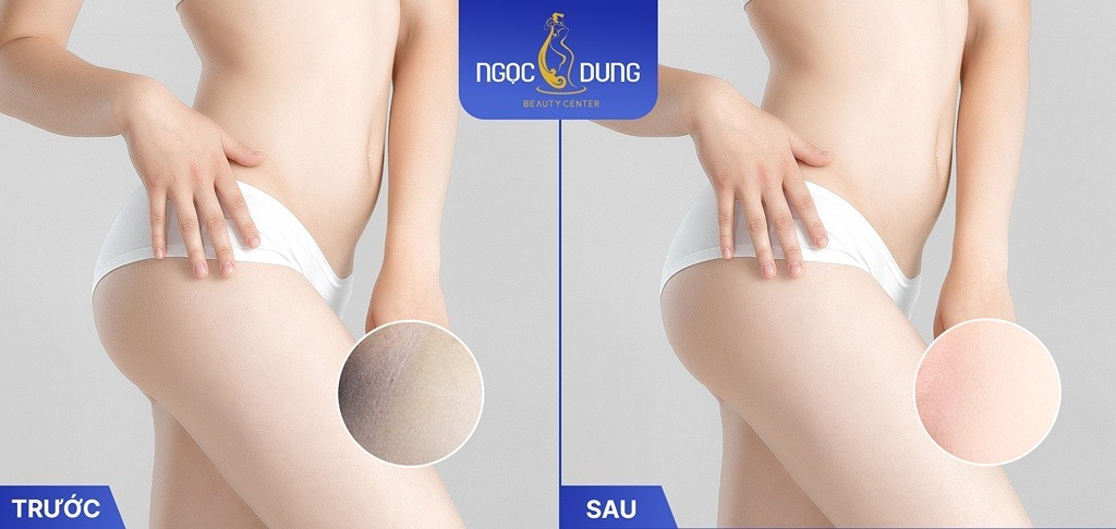 Giảm thâm bẹn chỉ sau 1 liệu trình tại Thẩm mỹ viện Ngọc Dung