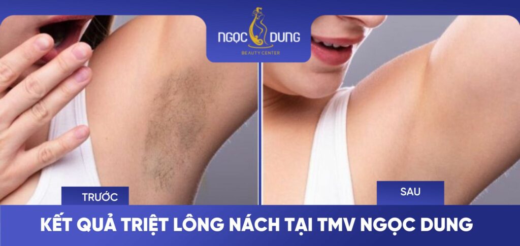 Kết quả triệt lông nách tại TMV Ngọc Dung