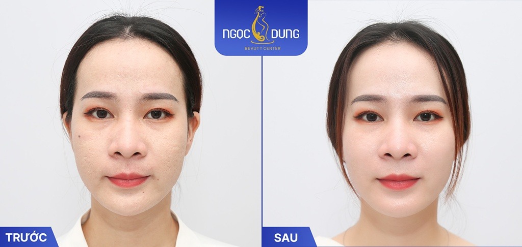 công nghệ điều trị sẹo rỗ Ultra nano