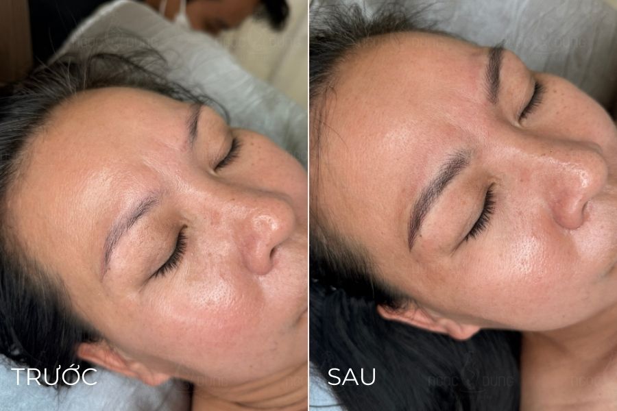Bạn có thể đến Ngọc Dung để xử lý tình trạng điêu khắc lông mày sau khi bong bị mất sợi