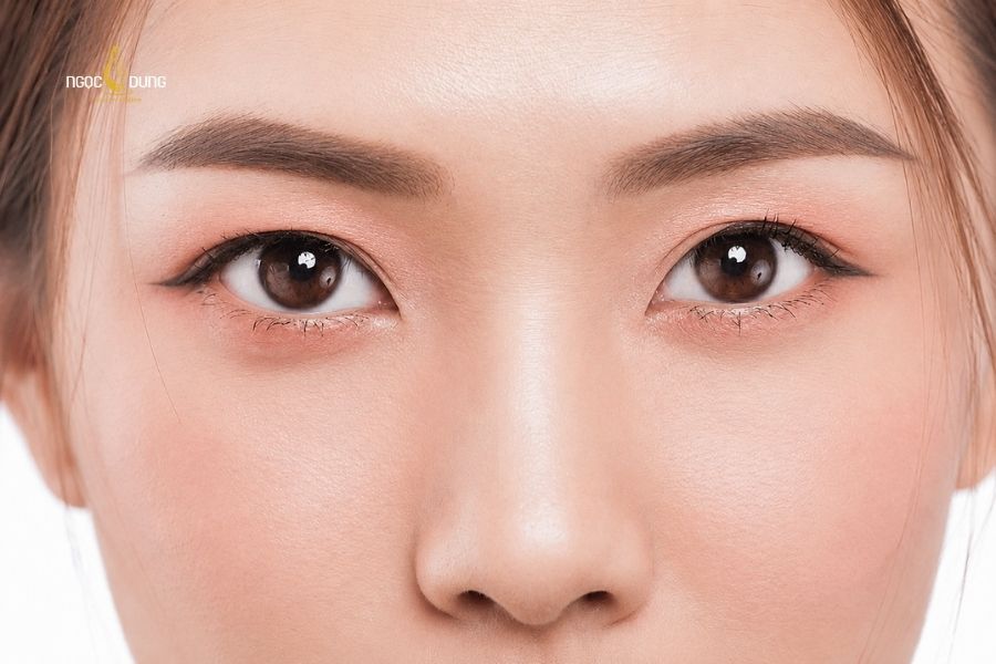 Mắt mí lót là gì? Đẹp hay xấu? Cách khắc phục hiệu quả 9 Mắt một mí lót thường do di truyền