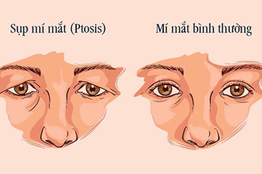 Hình ảnh của đôi mắt bị sụp mí