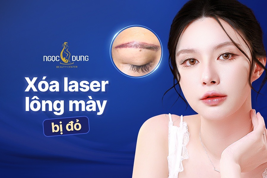 xóa laser lông mày bị đỏ