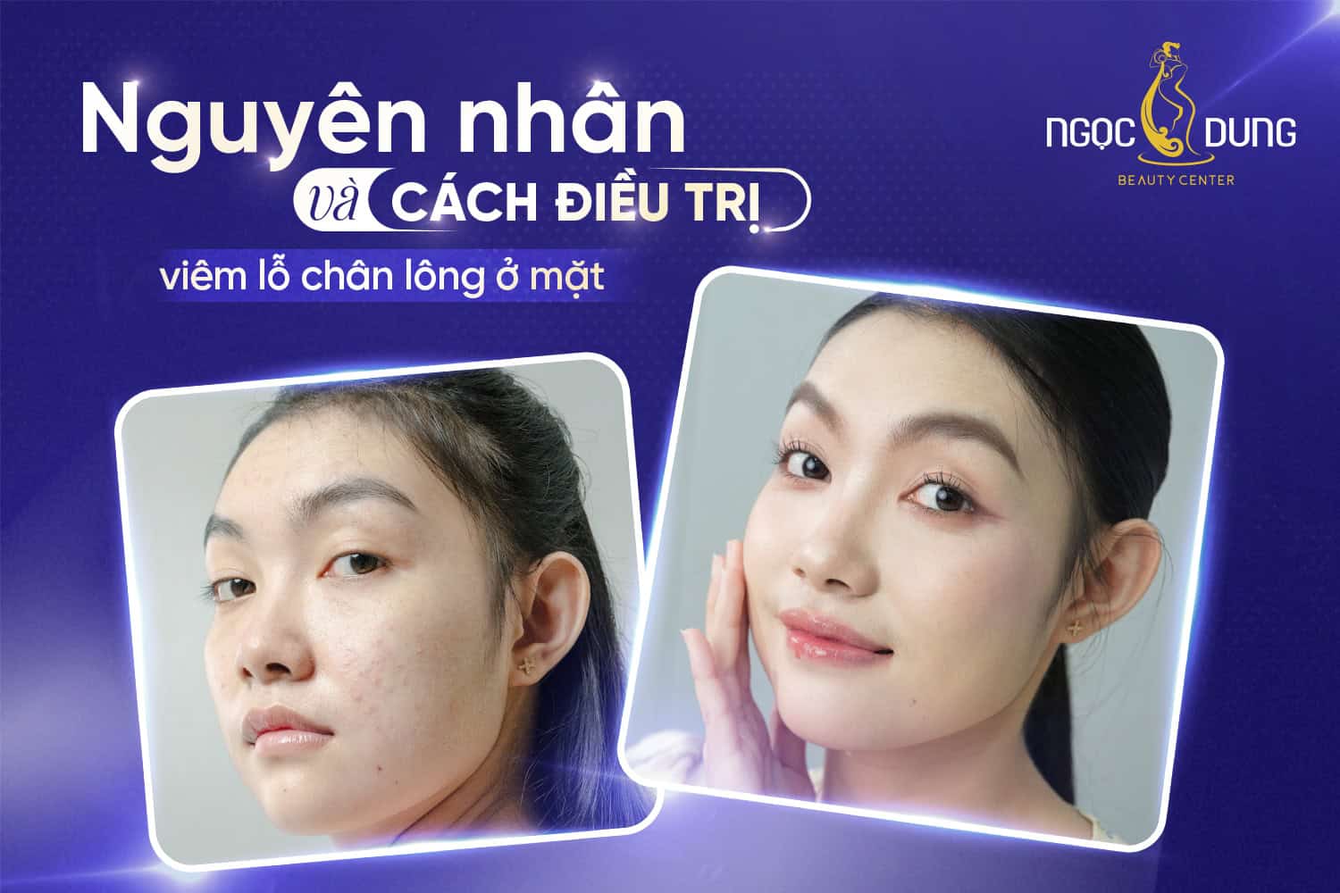 Nguyên nhân và cách điều trị viêm lỗ chân lông ở mặt 