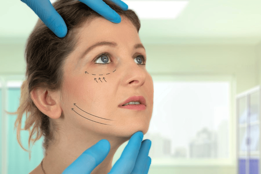 Tác dụng phụ của căng chỉ Collagen: Biến chứng và phòng ngừa 3 Căng chỉ Collagen dẫn đến sưng đỏ, bầm tím mặt và đau nhói