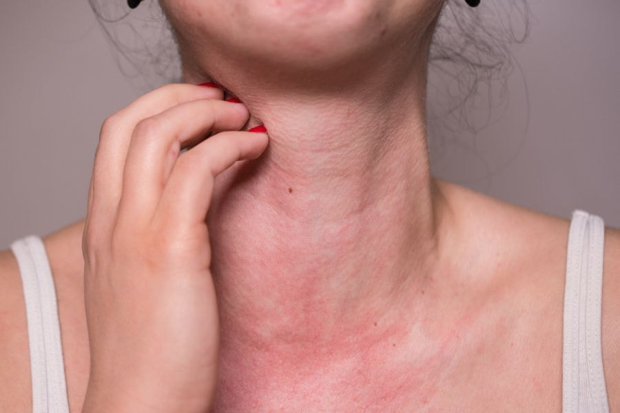 Dù hiếm gặp nhưng căng chỉ collagen vẫn có thể gây ra hiện tượng dị ứng ở da