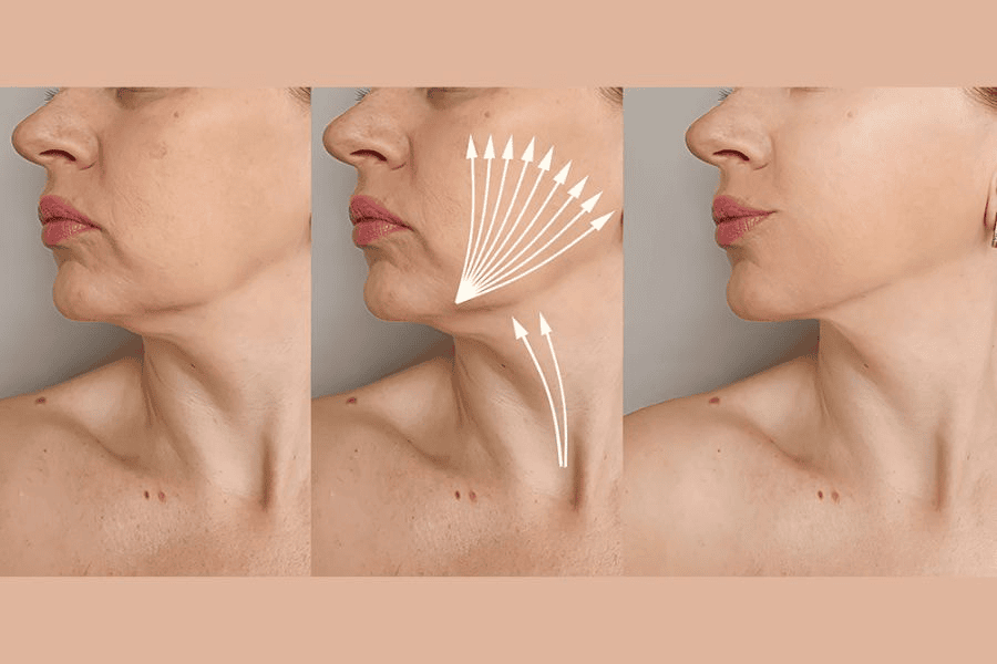 Căng chỉ collagen là kỹ thuật đưa các sợi chỉ sinh học (thường là chỉ PDO - Polydioxanone) vào dưới lớp hạ bì thông qua đầu kim siêu nhỏ