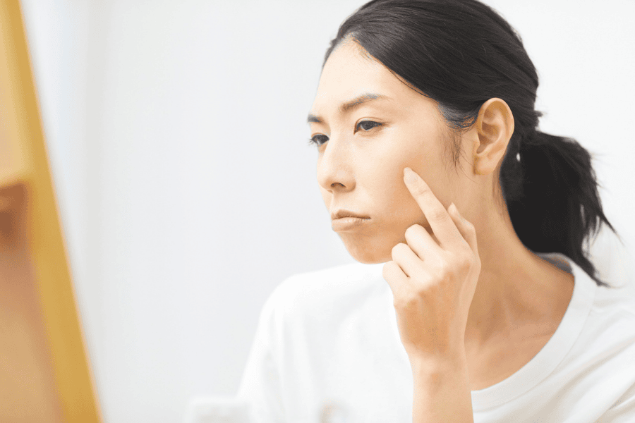 Da có thể bị căng rít nhẹ nếu dùng HA nồng độ cao trên da khô không được chuẩn bị đủ ẩm