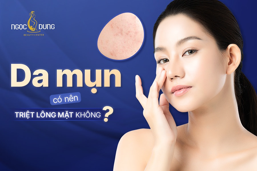 Da mụn có nên triệt lông mặt không