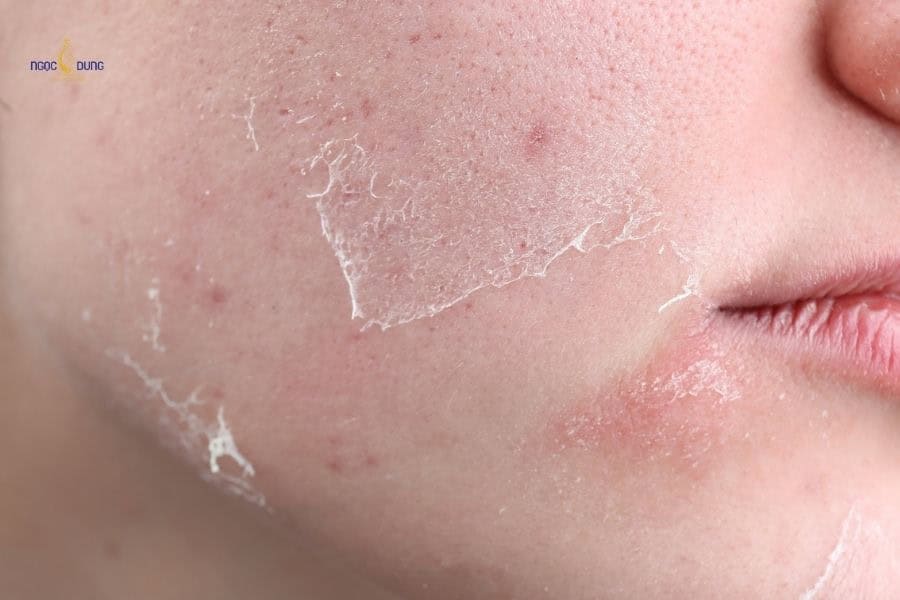 Microdermabrasion thường gây ra tình trạng da sần sùi và khô trong thời gian đầu