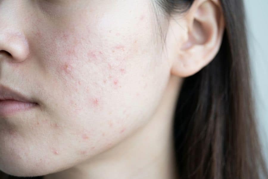 Da đang viêm, nhiễm trùng hoặc có tổn thương hở cần được kiểm soát trước khi mài da vi điểm