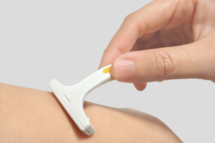 Dao cạo tạo vi vết thương, lông mọc ngược dưới da gây bít tắc và viêm nhiễm