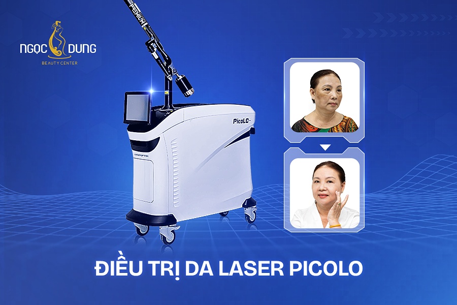 Điều trị da laser PicoLO