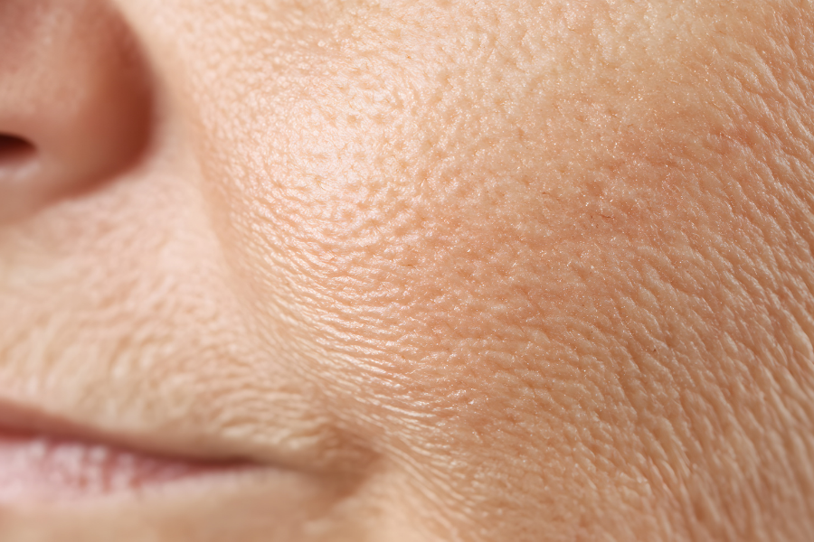 HA giúp ngăn ngừa lão hóa và làm mờ các nếp nhăn hiệu quả