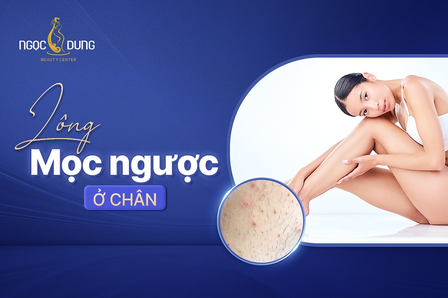 Lông mọc ngược ở chân