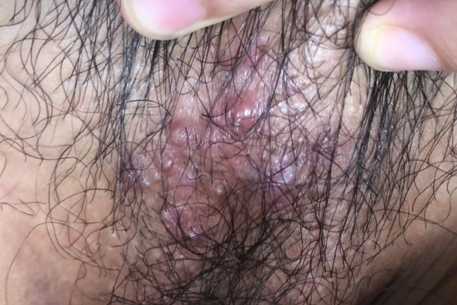 Lông vùng kín quá nhiều cũng dễ gây ra tình trạng nấm ngứa ở cô bé