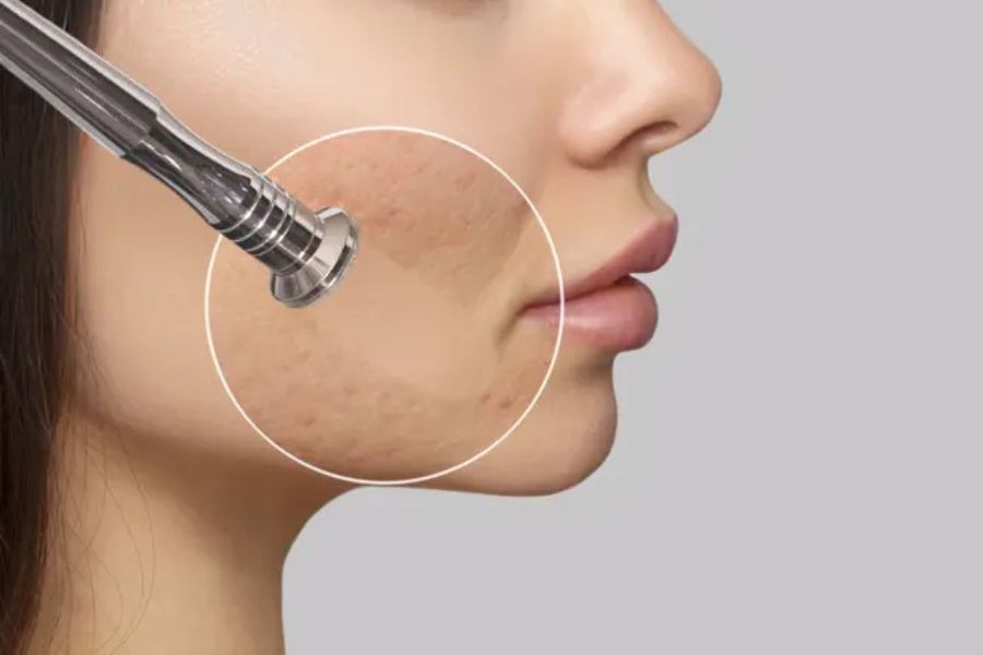 Microdermabrasion là một phương pháp tẩy da chết vật lý giúp làm mịn da, nhưng cần thời gian lâu dài để thấy kết quả