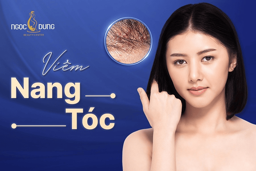 Nguyên nhân, dấu hiệu và cách điều trị viêm nang tóc