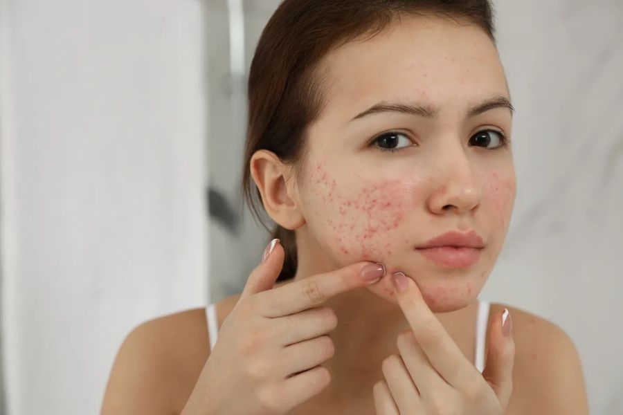 Khi lỗ chân lông bị bít tắc, nhiễm khuẩn thì sẽ dễ gây ra viêm nang lông