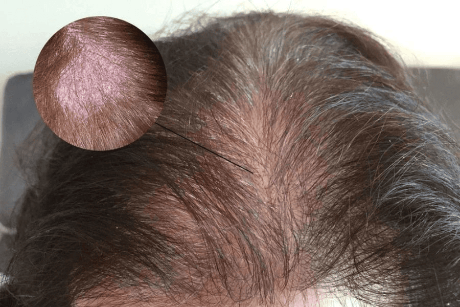 Những dấu hiệu nhận biết viêm nang tóc