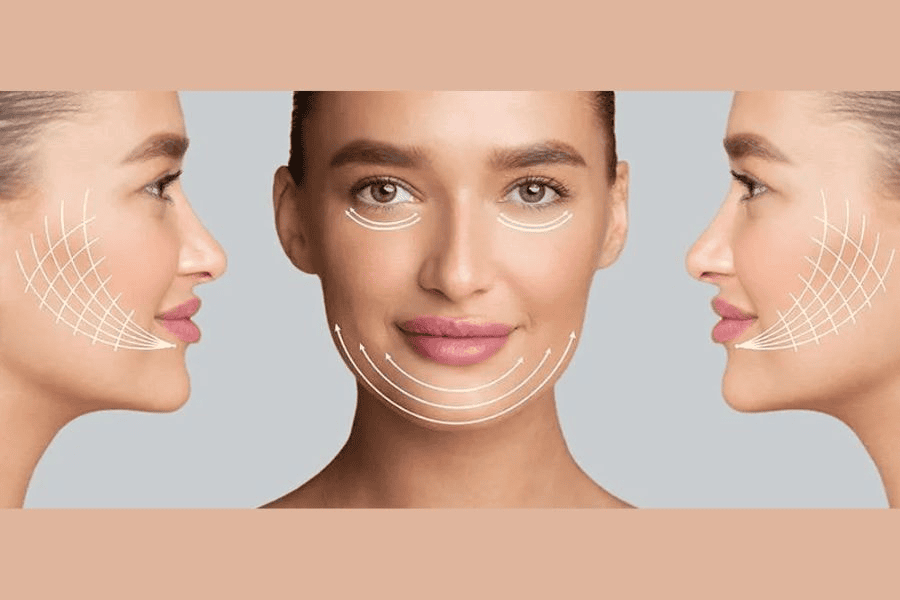 Những đối tượng nên cân nhắc căng chỉ collagen