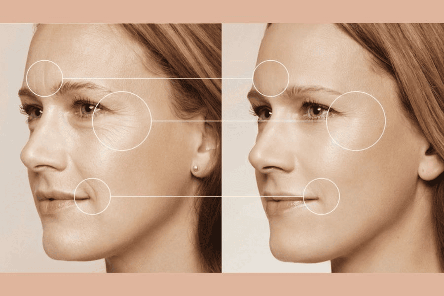 Những lưu ý khi lựa chọn căng chỉ vùng mắt 