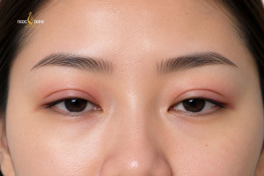 Phun xăm mí mắt bị sưng thì phải làm sao? Có sao không? 13 Sưng mí mắt sau khi phun xăm là hiện tượng bình thường
